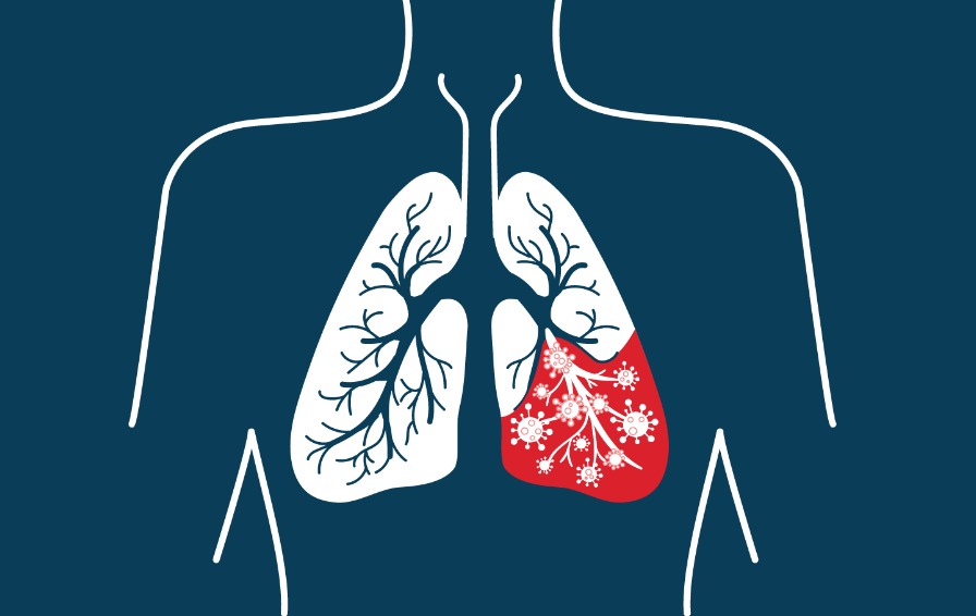 Dia Mundial da Pneumonia: Saúde de Andradina reforça alerta para prevenção e vacinação