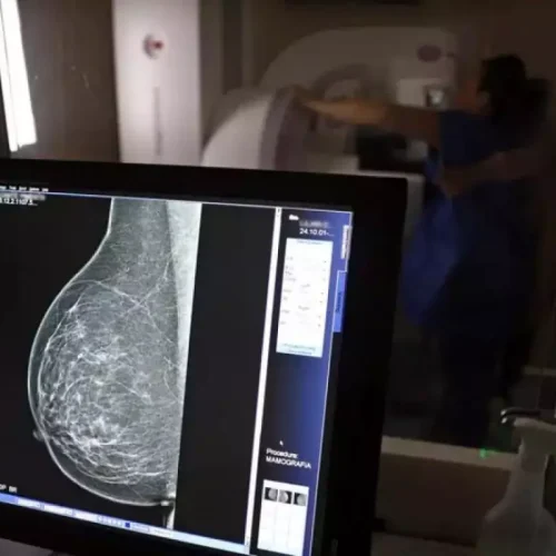 SUS garante mamografia para mulheres a partir dos 40 anos