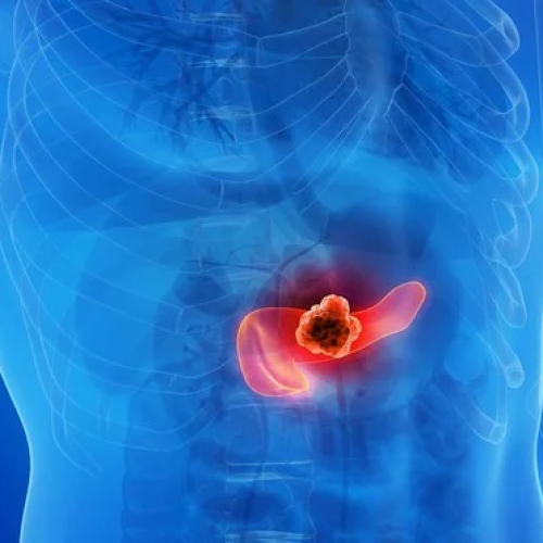 Combinação de três remédios elimina câncer de pâncreas em testes com animais