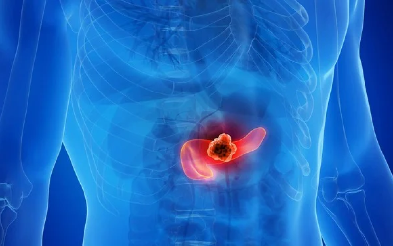 Combinação de três remédios elimina câncer de pâncreas em testes com animais