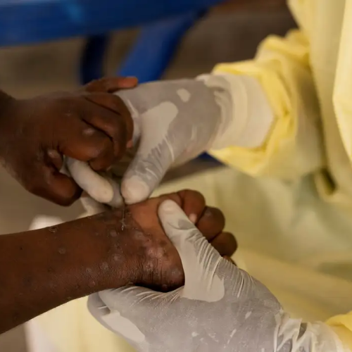 Brasil registra 88 casos de Mpox em 2026; saiba como evitar a doença