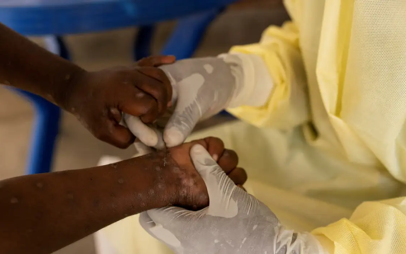 Brasil registra 88 casos de Mpox em 2026; saiba como evitar a doença