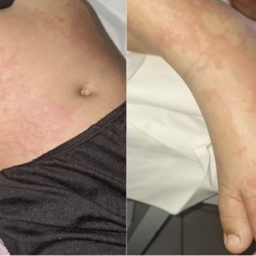Criança contrai infecção após contato com detergente Ypê