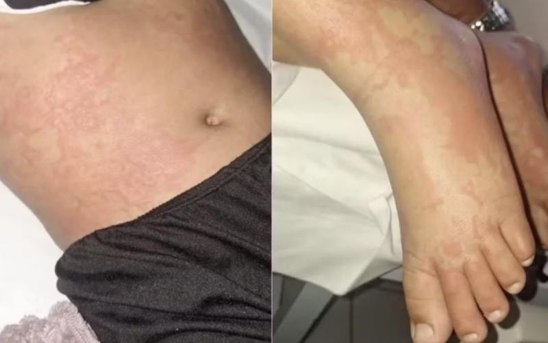 Criança contrai infecção após contato com detergente Ypê